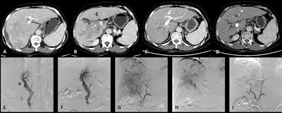 Evaluation of D-TACE combined with endovascular brachytherapy for HCC with MPVTT